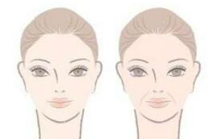 *Botox除皱需要多少费用?让你小脸变得更加精致